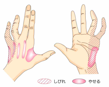 手の痛み おおつか整形外科blog