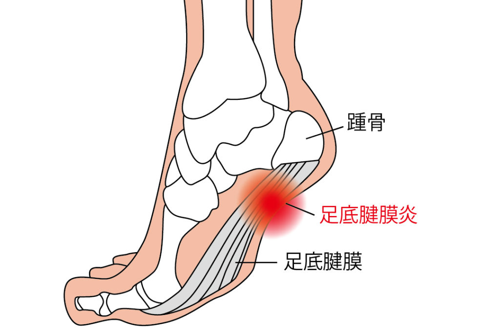 足底腱膜炎 – おおつか整形外科BLOG